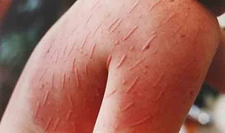 Kurdeşen Hastalığı Belirtileri ve Tedavisi