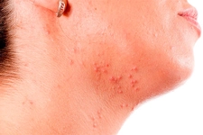 Kurdeşen Nedenleri Kurdeşen Neden Oluşur