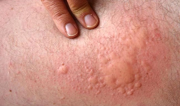 Kurdeşen Kaç Günde Geçer